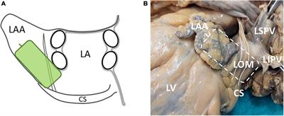 Optimization of intra-operative electrophysiological localization of the ligament of Marshall